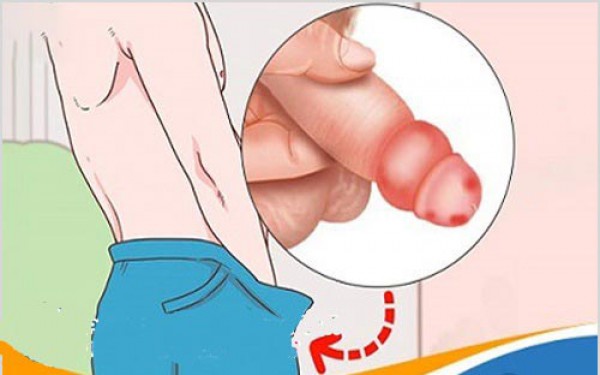 Bao quy đầu bị sưng mọng nước phồng lên như cục mỡ là bệnh gì?