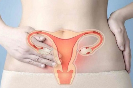 90% phụ nữ Việt Nam từng mắc bệnh phụ khoa