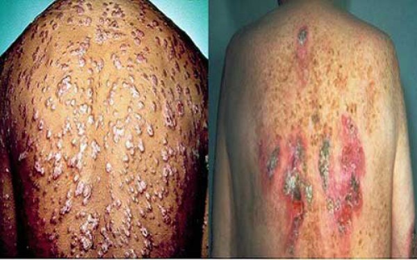 9 Cách chữa bệnh giang mai ở nam, nữ giới hiệu quả tại nhà
