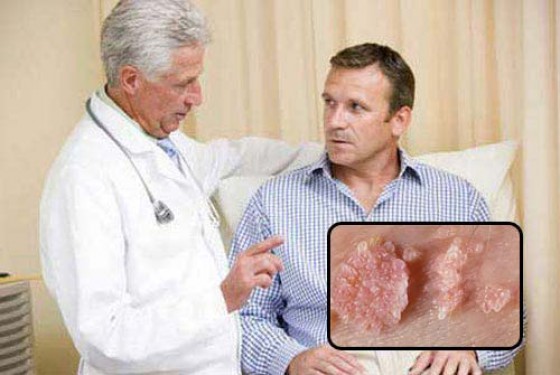 9 Cách chữa bệnh sùi mào gà ở nam, nữ giới hiệu quả triệt để