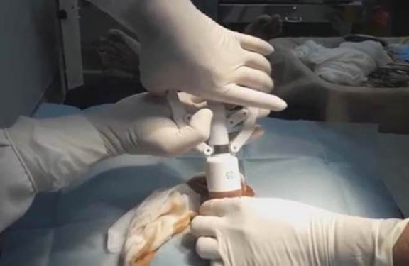 Cắt bao quy đầu có được bảo hiểm y tế chi trả không?