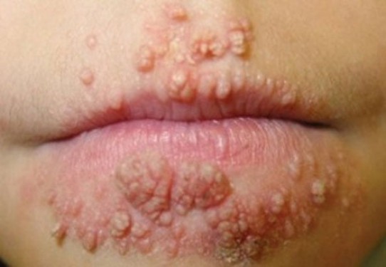 Chi phí chữa bệnh sùi mào gà hết bao nhiêu tiền giá khám xét nghiệm