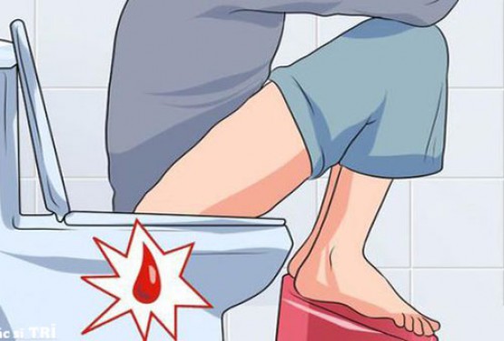 Đi ngoài ra máu tươi nhưng không đau là bệnh gì? Cách chữa trị