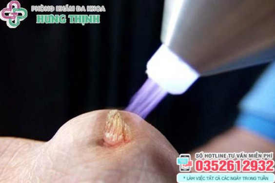 Đốt sùi mào gà bao lâu thì khỏi, có đau không, để lại sẹo không