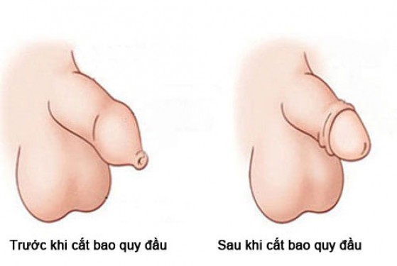 Hình ảnh sau khi cắt bao quy đầu (đã lành, bị phù nề)