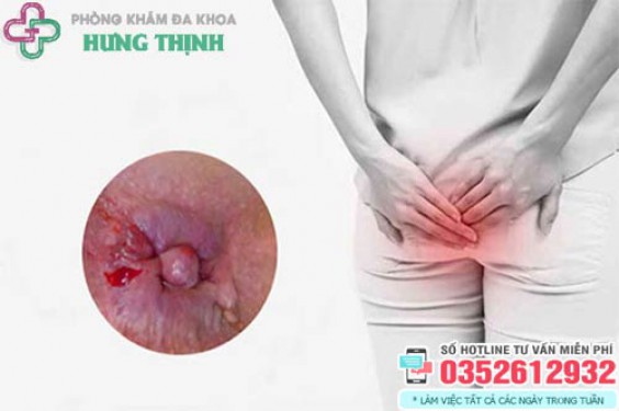 Lòi cục thịt ở hậu môn không đau không rát là bệnh gì?