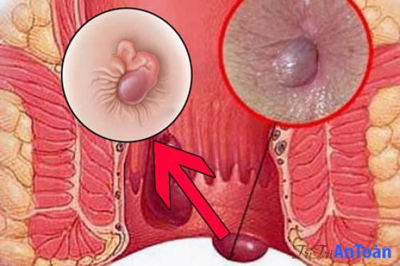 10 Bệnh viện phòng khám chữa bệnh trĩ ở đâu tốt Hà Nội mổ cắt trĩ