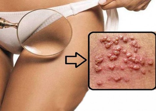 Nổi mụn vùng kín khám ở đâu? Top 6 địa chỉ uy tín ở Hà Nội