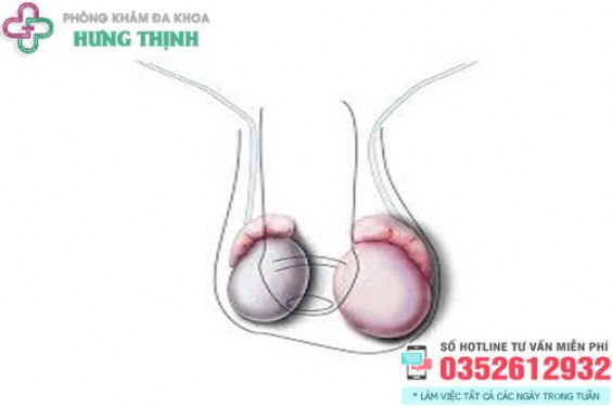 Tinh hoàn bên to bên nhỏ có sao không?