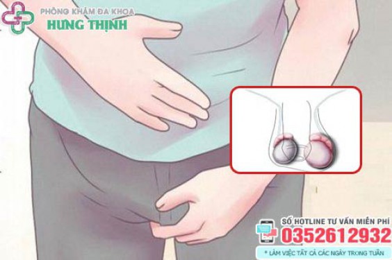 Tinh hoàn bị sưng 1 bên có sao không? Cách chữa trị