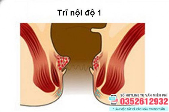 Trĩ nội độ 1, 2 có nguy hiểm không? Cách chữa trị hiệu quả