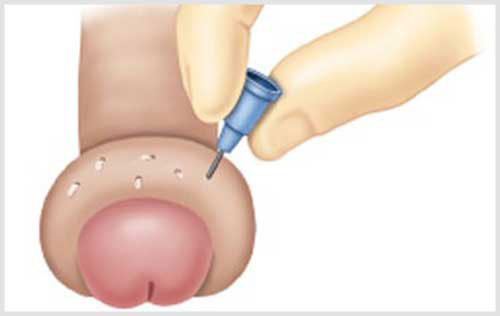 Bao quy đầu bị sưng mọng nước