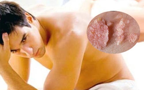 Bệnh sùi mào gà có gây ung thư không?