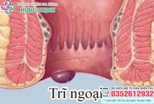 Cách chữa bệnh trĩ ngoại tại nhà