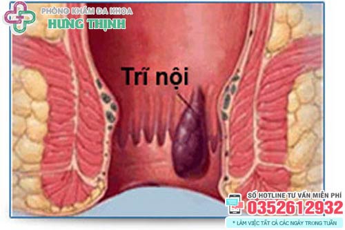 Cách chữa bệnh trĩ nội tại nhà