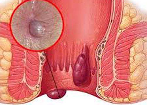 Cách chữa bệnh trĩ ngoại tại nhà