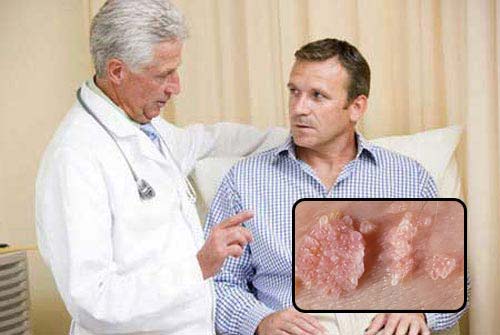 Cách chữa bệnh sùi mào gà hiệu quả hiện nay
