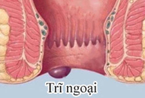 Cách làm co búi trĩ ngoại tại nhà