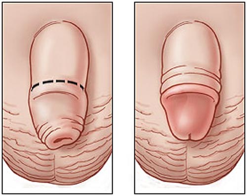 Chi phí cắt bao quy đầu bao nhiêu tiền