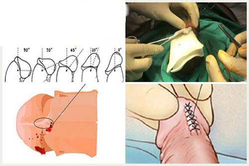 Chi phí cắt dây hãm bao quy đầu bao nhiêu tiền
