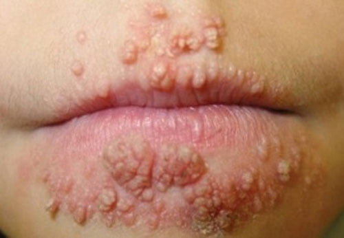 Chi phí chữa bệnh sùi mào gà hết bao nhiêu tiền