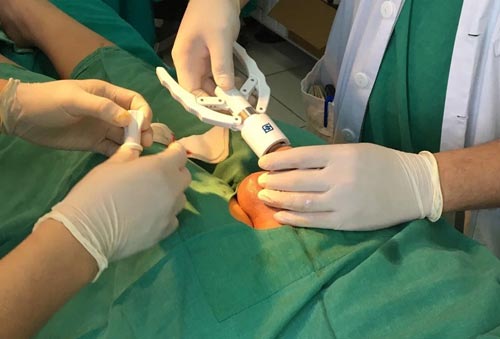 Dấu hiệu nhiễm trùng sau khi cắt bao quy đầu