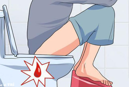 Đi ngoài ra máu nhưng không đau là bệnh gì?