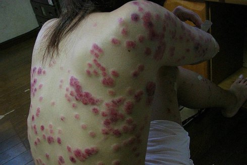 Hình ảnh bệnh giang mai ở nữ giới