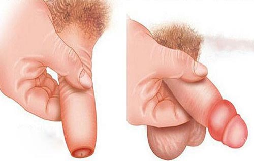 Hình ảnh sau khi cắt bao quy đầu bị phù nề