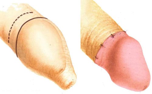 Hình ảnh sau khi cắt bao quy đầu đã lành bình thường