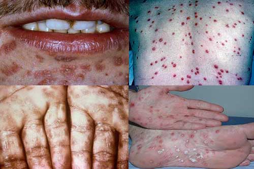 Khám chữa bệnh giang mai ở đâu