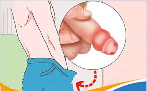 Khám viêm bao quy đầu ở đâu Hà Nội