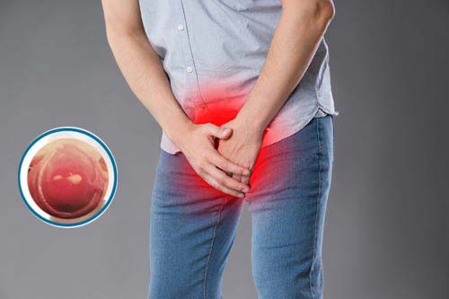 Lỗ sáo bị sưng đỏ là dấu hiệu bệnh gì?