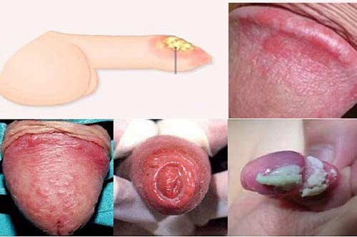 Lỗ sáo bị sưng tấy đỏ do viêm quy đầu