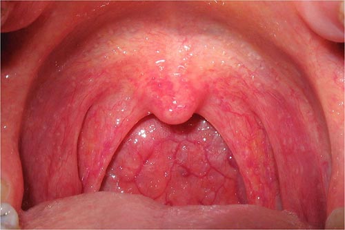 Nguy cơ mắc bệnh tim do viêm họng cấp
