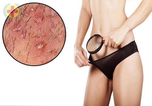 Nổi mụn vùng kín là bệnh gì?