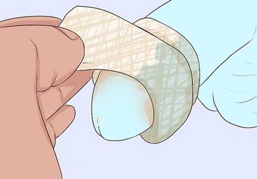 Phòng tránh cắt bao quy đầu bị phù nề