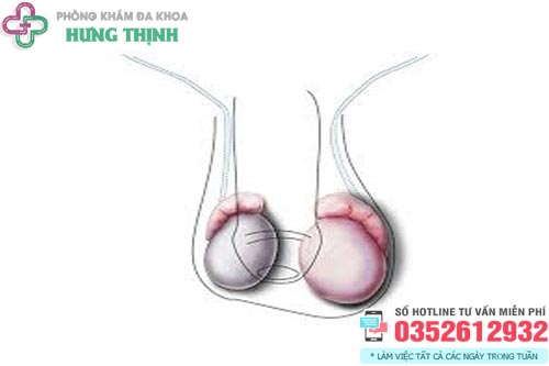 Tinh hoàn bên to bên nhỏ có sao không?