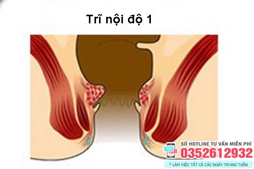 Trĩ nội độ 1 có nguy hiểm không